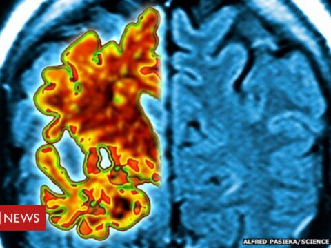 Alzheimer’s: ‘Promising’ blood test for early stage of disease