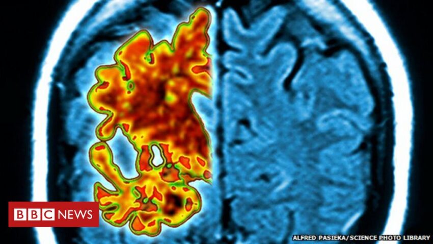 Alzheimer’s: ‘Promising’ blood test for early stage of disease