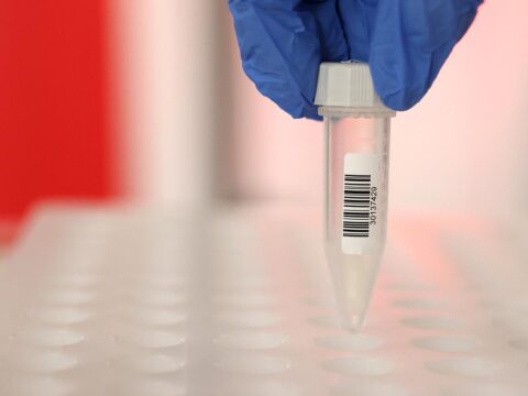 A more cost effective saliva take a look at seeks FDA approval; stroke dangers in youthful patients